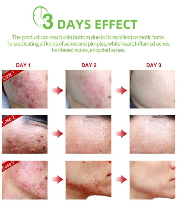 OEM Fast Effective Repair Pimple Scar Anti Spots Removal Acne Gel Smooth Skin Shrink Pores Salicylic Acid Acne Face Cream - Image 2