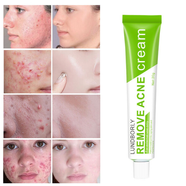 OEM Fast Effective Repair Pimple Scar Anti Spots Removal Acne Gel Smooth Skin Shrink Pores Salicylic Acid Acne Face Cream - Image 4