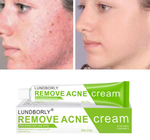 OEM Fast Effective Repair Pimple Scar Anti Spots Removal Acne Gel Smooth Skin Shrink Pores Salicylic Acid Acne Face Cream - Image 5